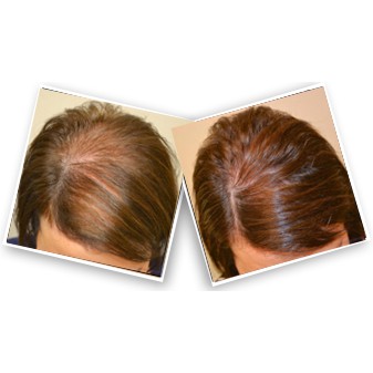 Dung Dịch Mọc Tóc - Mọc Lông Vùng Kín Nữ Minoxidil Basic Care 5% Dạng Bọt (Hỗ Trợ Che Tên Sản Phẩm)
