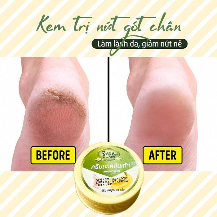 [HCM]Kem Thoa Nứt Gót Chân (Thái Lan)