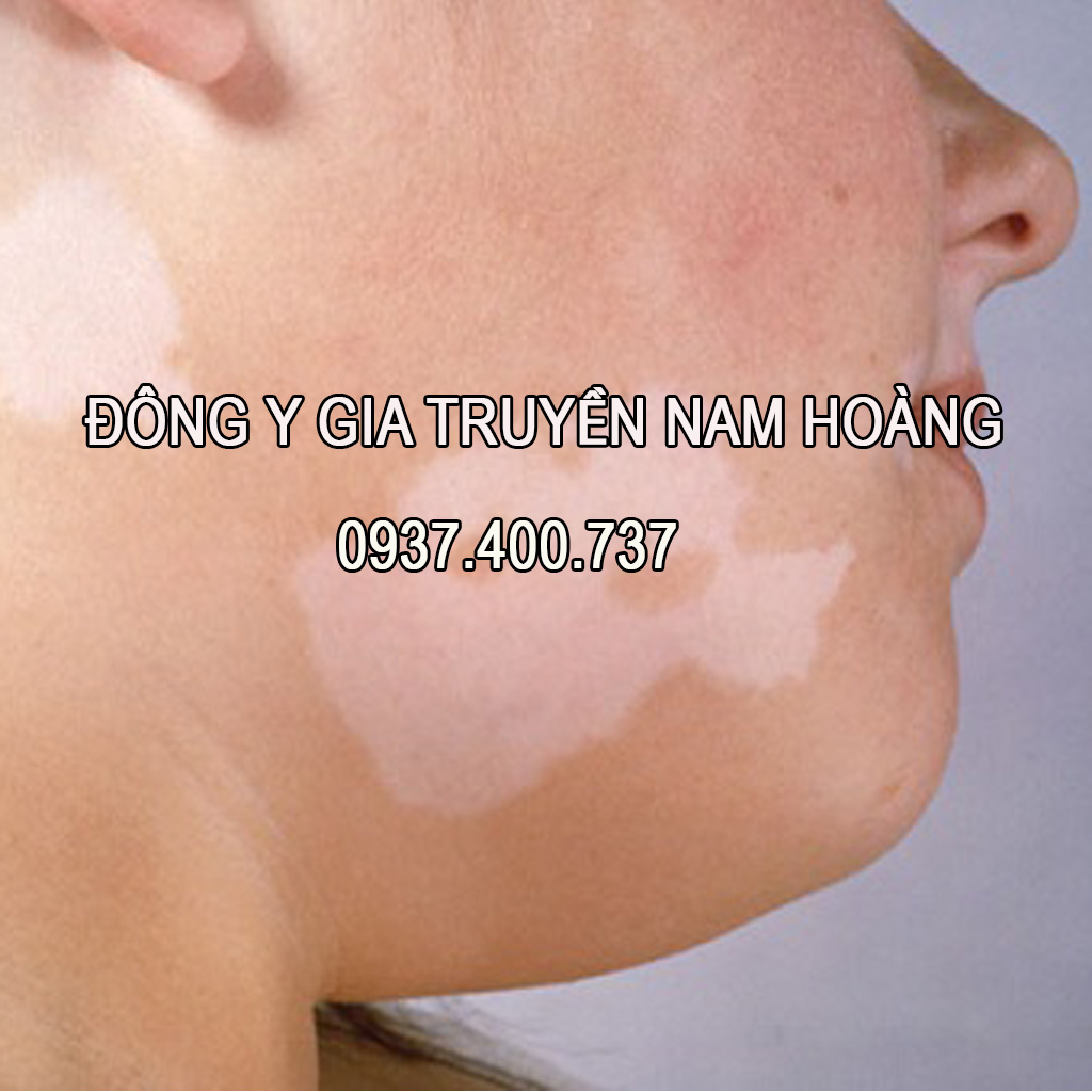 Thuốc Đặc Trị Bệnh Lang Ben Nam Hoàng