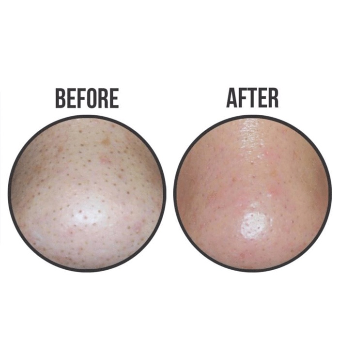 Miếng Đẩy Mụn Đầu Đen Ciracle Goodbye Blackhead
