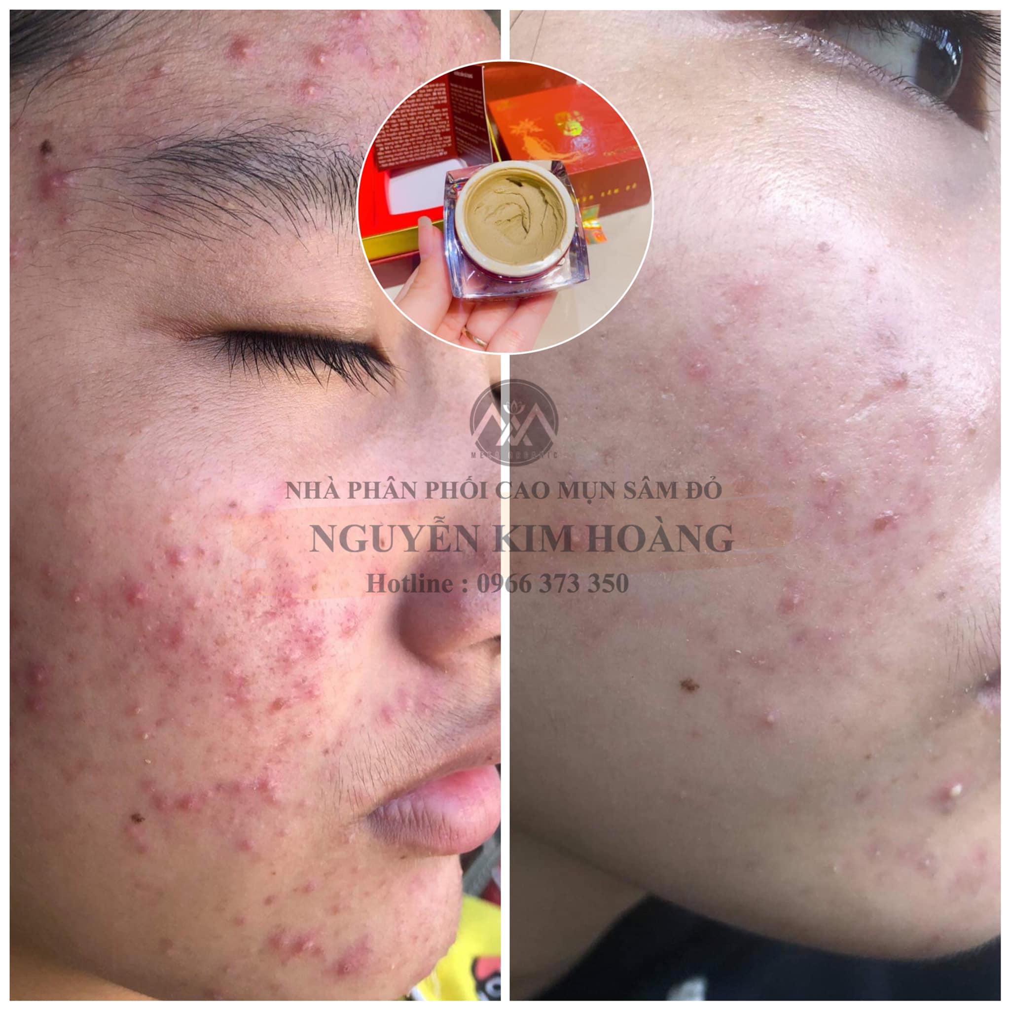 Cao Mụn Sâm Đỏ 36 Vị Meea Organic Giảm Mụn Mờ Thâm 15g