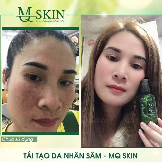 [HCM]COMBO SERUM THAY DA + KEM FACE NHÂN SÂM MQ SKIN