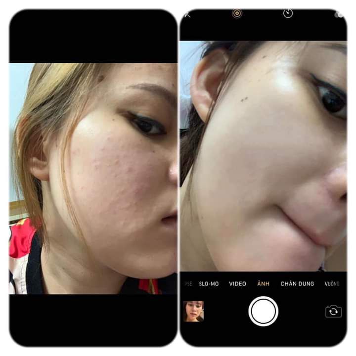 Serum Nhân Sâm Phục hồi da mỏng chỉ đỏ
