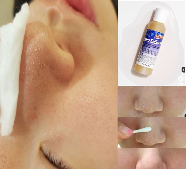 Dung Dịch Ủ Mụn Đầu Đen Medi-Peel Extra Super 9 + (100ml)
