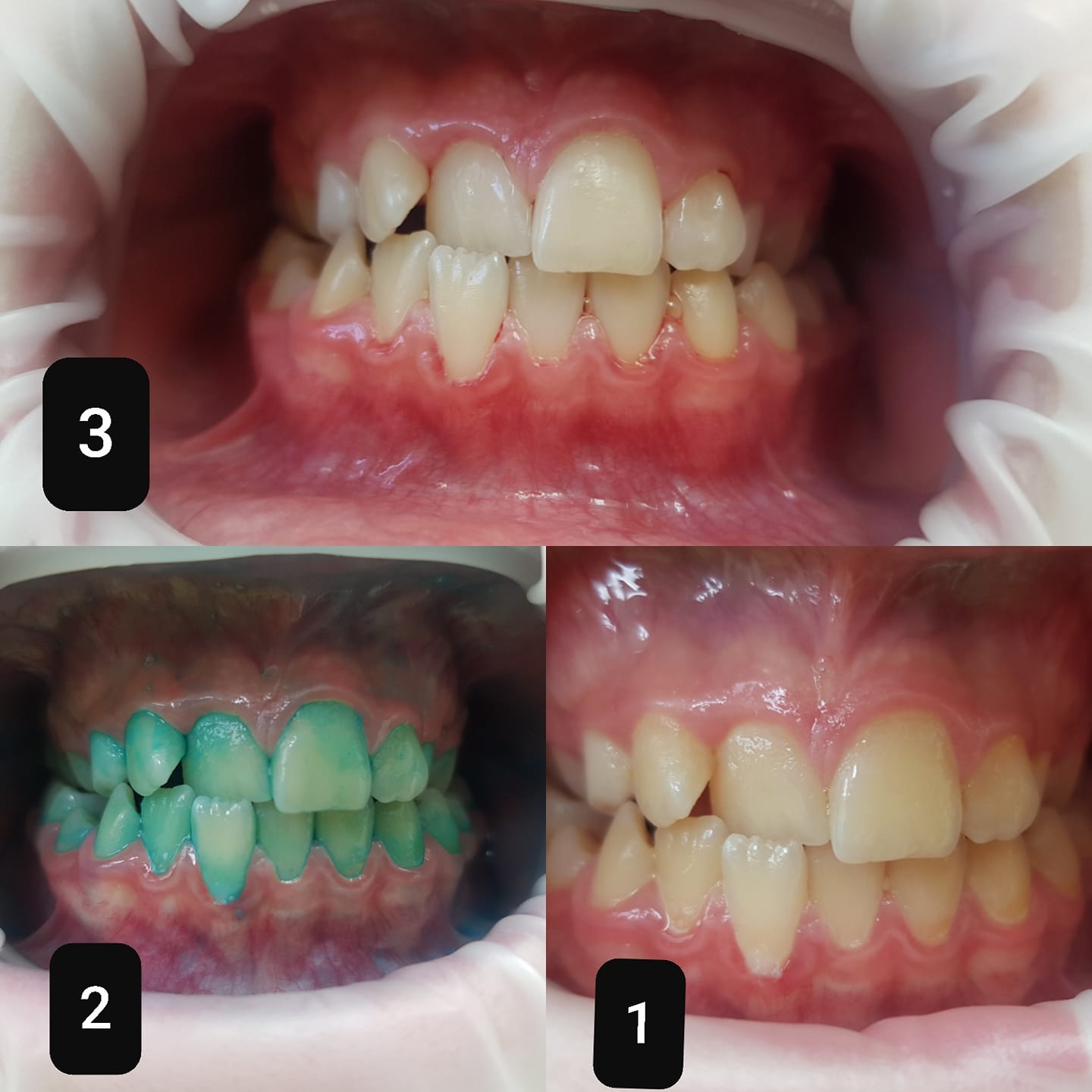 Nước súc miệng phát hiện mảng bám (chỉ thị mảng bám) Miradent Plaque Agent / Đức