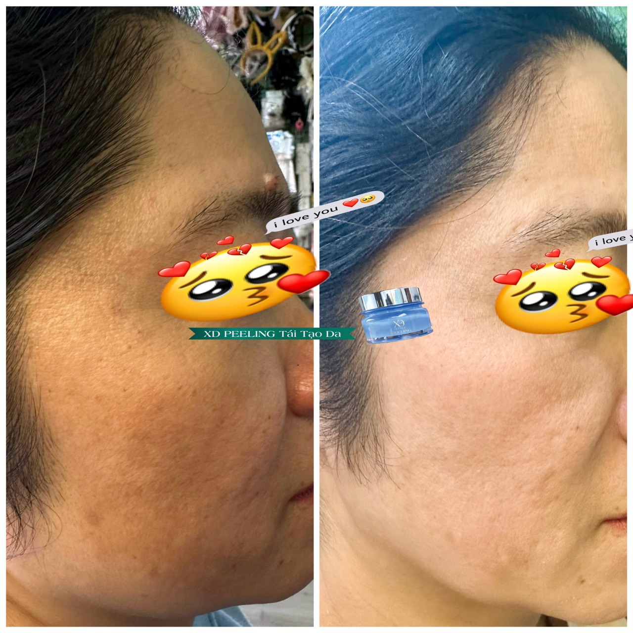[HCM]Sỉ 10 Hộp Kem Peeling Tái Tạo Da