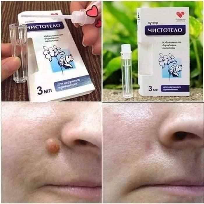 Gel tẩy nốt ruồi Nga