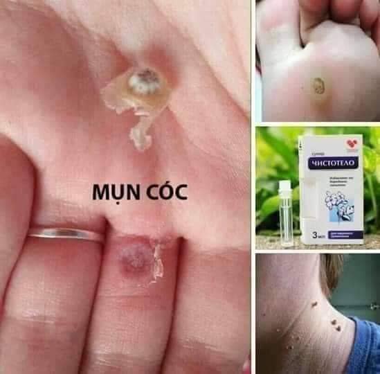 Gel tẩy nốt ruồi 12ml của Nga- trang shop