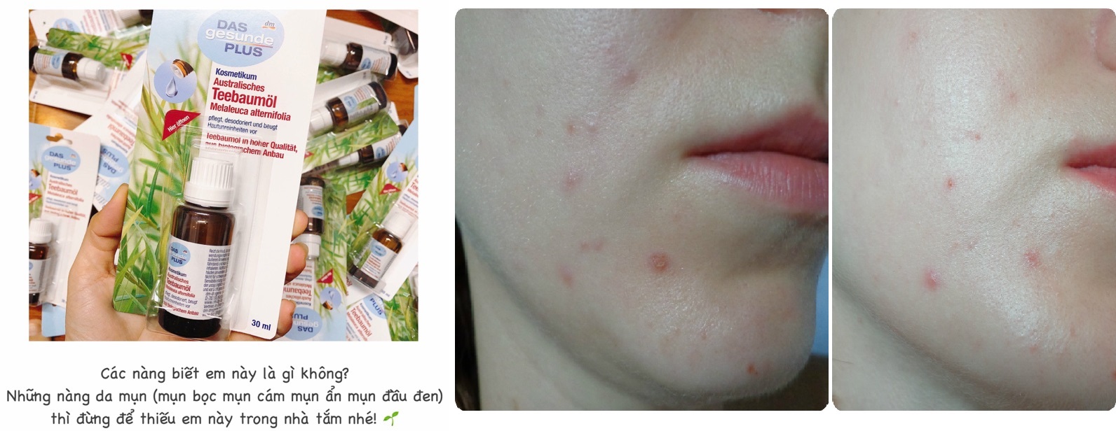 (Review) Tinh dầu tràm trà Mivolis nội địa Đức