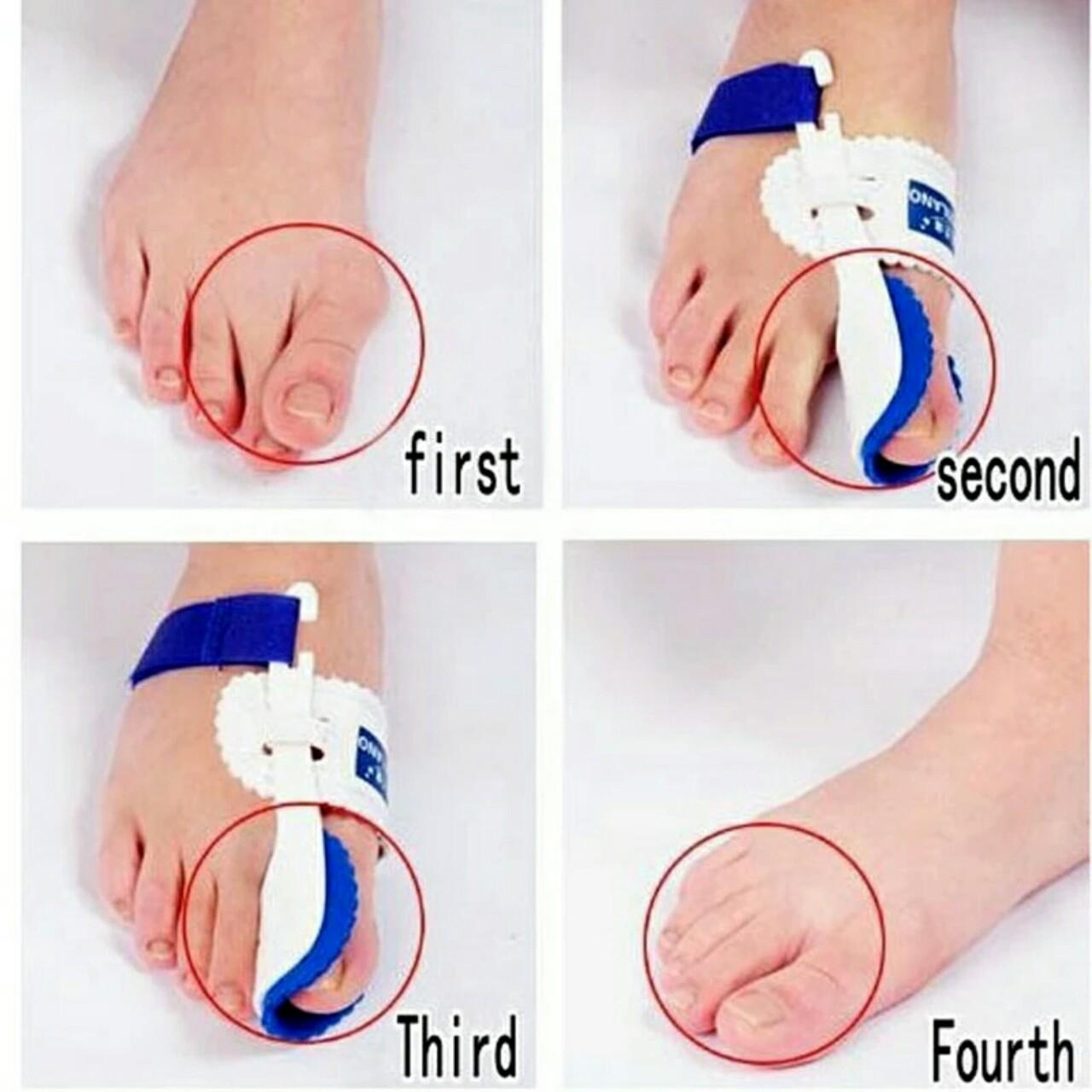 DỤNG CỤ NẸP ĐỊNH HÌNH NGÓN CHÂN CÁI