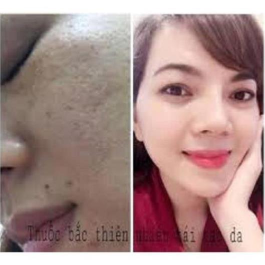 TÁI TẠO DA THUỐT BẮC ANGEL 50ML