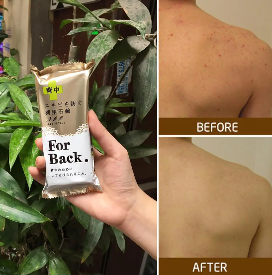 Xà phòng hỗ trợ giảm mụn lưng For Back 135g