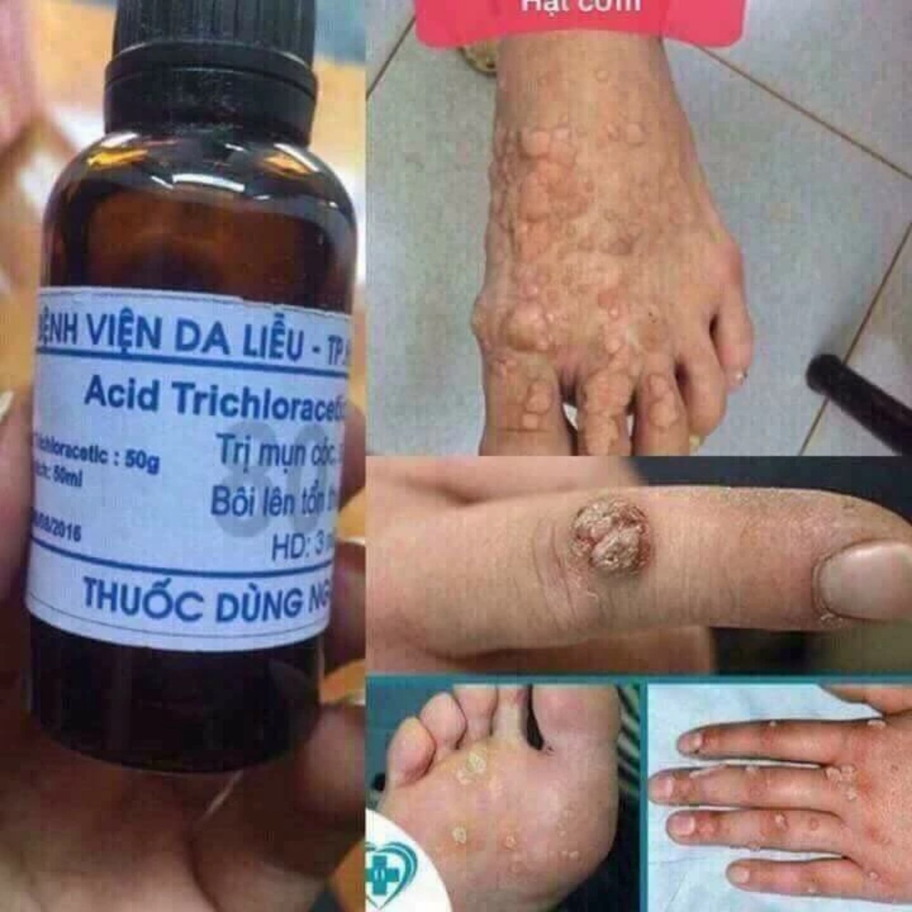 lọ tẩy mụn cóc, mụn cơm, nốt ruồi, mắt cá, mụn thịt cực hiệu quả