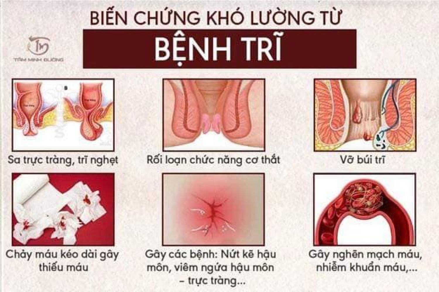 Combo Bôi và Đặt Trĩ DOPROCT Thái Lan