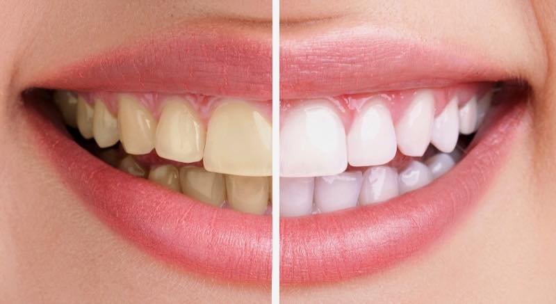 thuốc tẩy trắng răng philipin (bật tông cực trắng. không gây ê buốt)