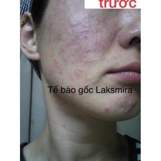 ( Mẫu Mới 2019 ) TẾ BÀO GỐC LAKSMIRA STEM CELL SOLUTION ( Lẻ 1 ống )