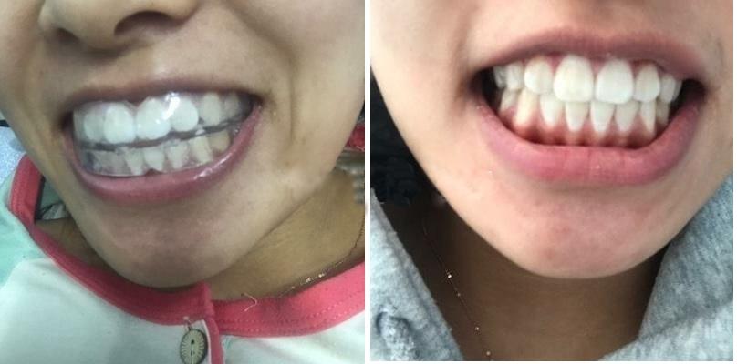 [HCM]Bộ Niềng Răng Tại Nhà - Dành Cho Người Lớn A1+A2+A3