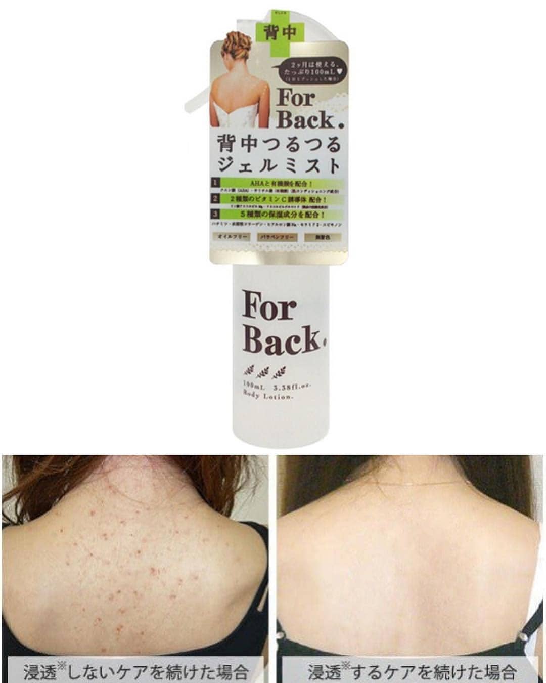 [HCM]Xịt mụn lưng For Back Body Lotion 100ml