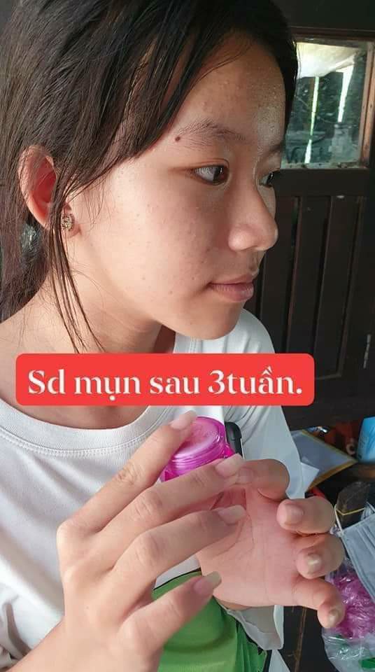 Combo 5 Hộp Kem Mụn 2C