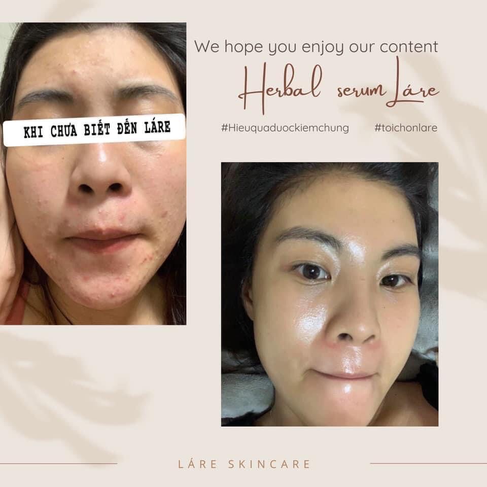 Serum thảo mộc thanh dược Lare 80ml