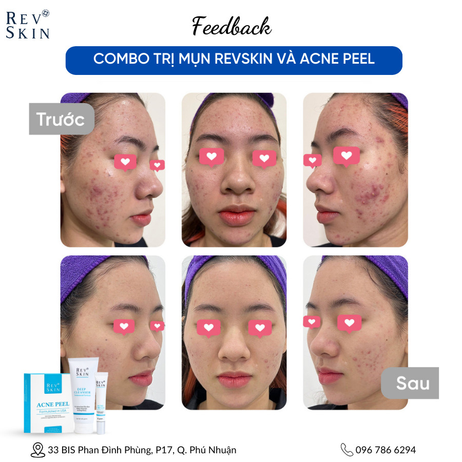 Bộ Peel Mụn- Acne Peel