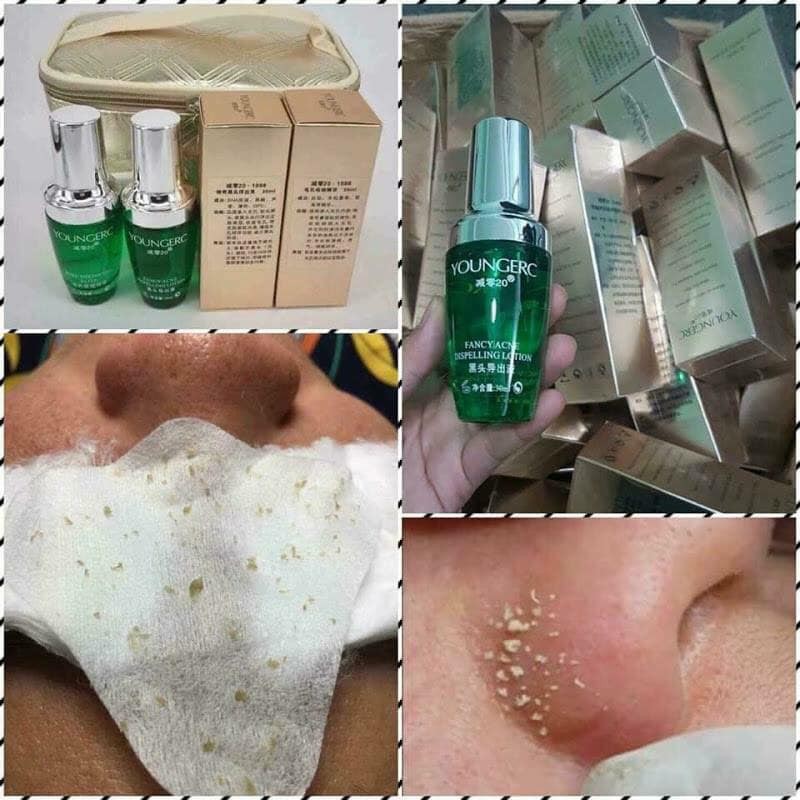 Ủ mụn đầu đen, mụn cám YOUNGER