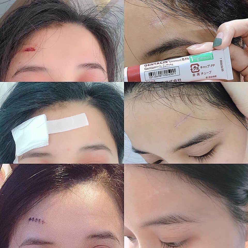 [HCM]Gel Làm Mờ Sẹo MSD Gentacin Ointment 0.1- Gentamicin Sulfate - 10g