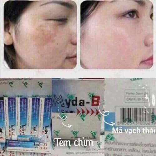 Kem nám tàn nhang Myda B Thái Lan