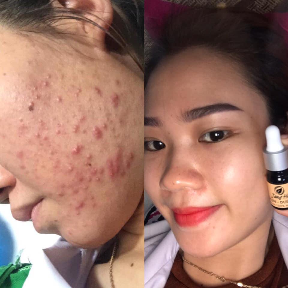 [HCM]Trị mụn Jang Hy
