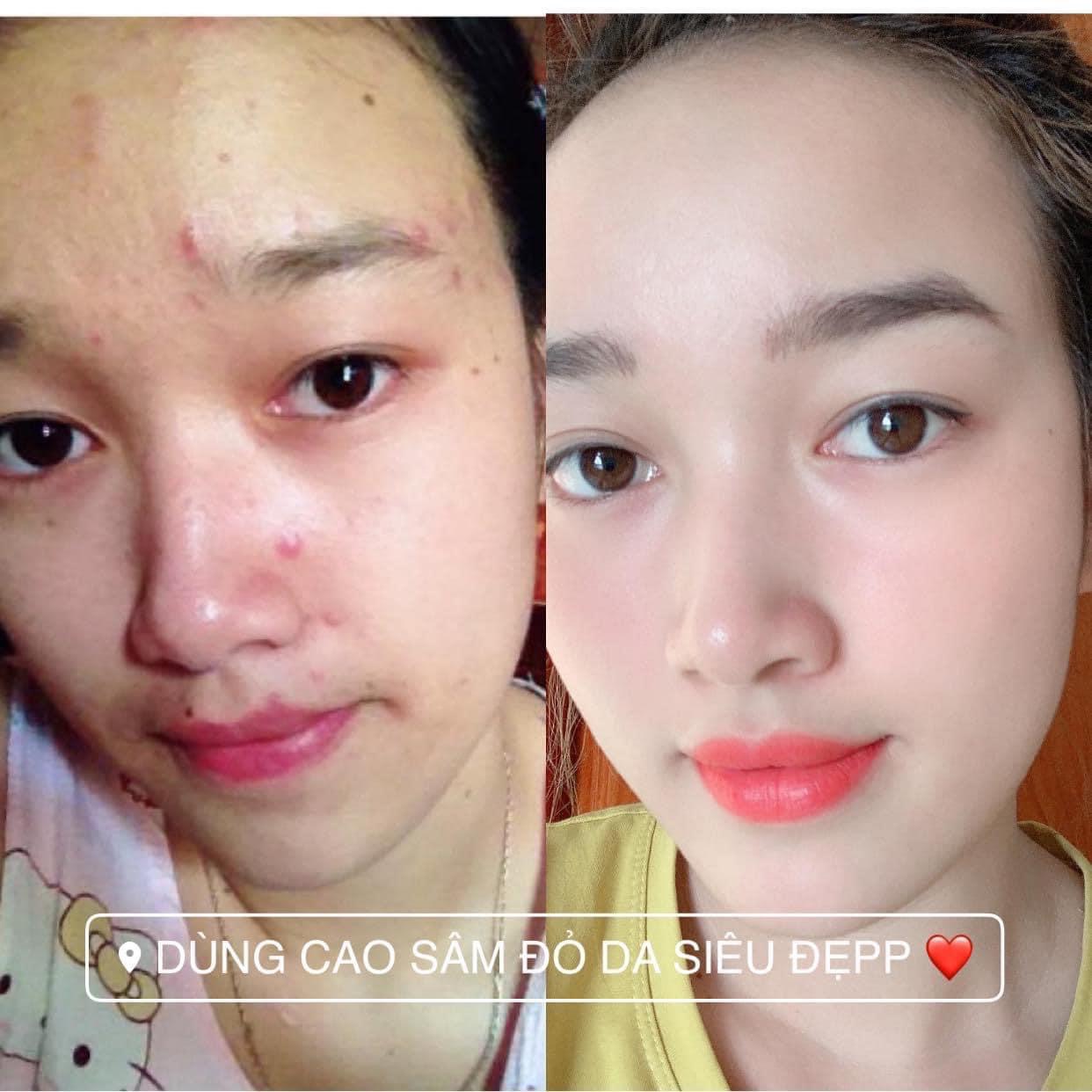 [HCM]Cao m ụn sâm đỏ 15g - Cao sâm đỏ - Cao tri. mun - Kem tri. mun