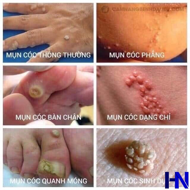 Chấm Mụn Cóc, Mụn Ruồi CONCON (Chính hãng Thái Lan)