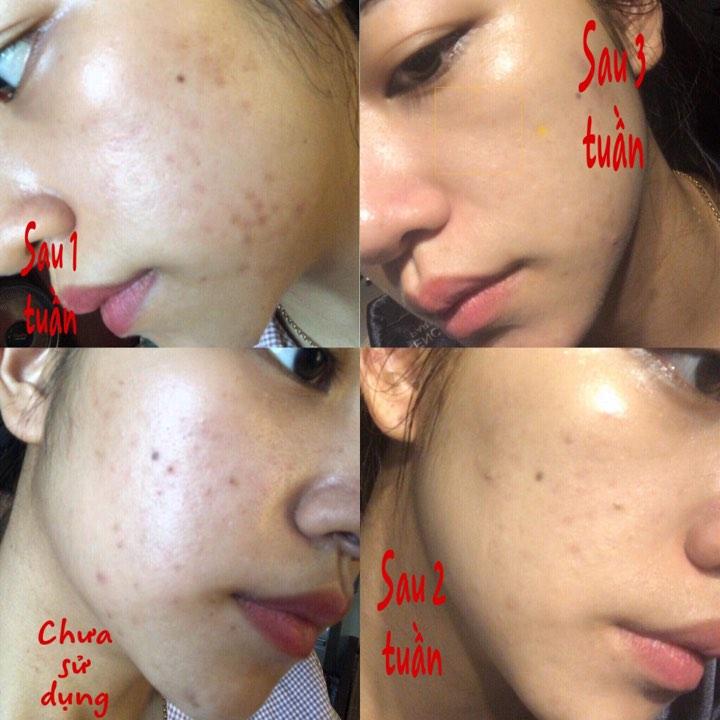 Combo 3 hộp kem mụn thảo dược Hoa Đào