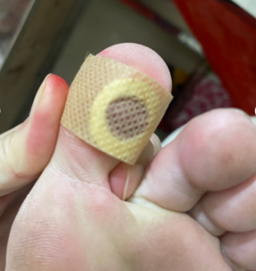 6 MIẾNG DÁN MỤN CÓC - HIỆU QUẢ, TIỆN LỢI
