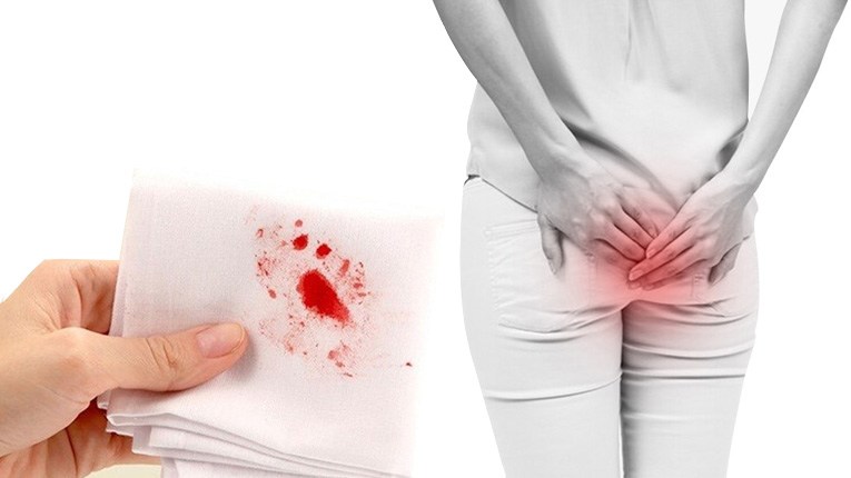/Trắng Đỏ/ kem bôi trĩ thảo mộc cực hiệu quả