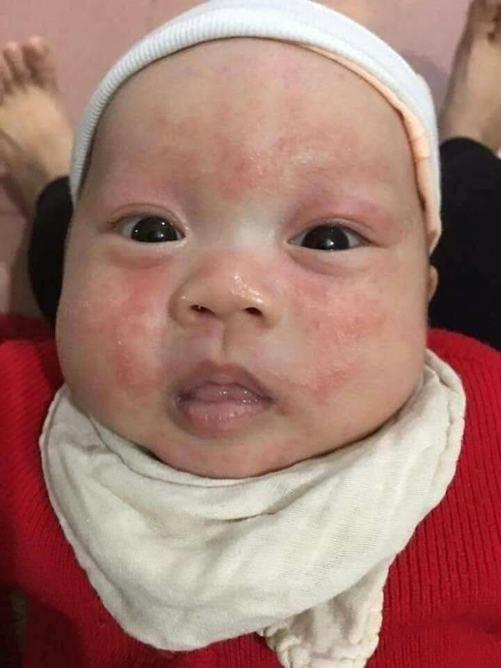 Đông Y Đa Năng Bà Vân Các Bệnh Ngoài Da