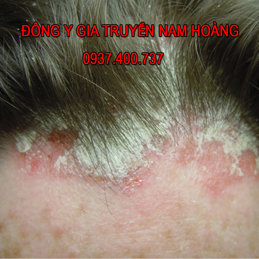 Dược Phẩm Trị Bệnh Nấm Da Đầu Nam Hoàng