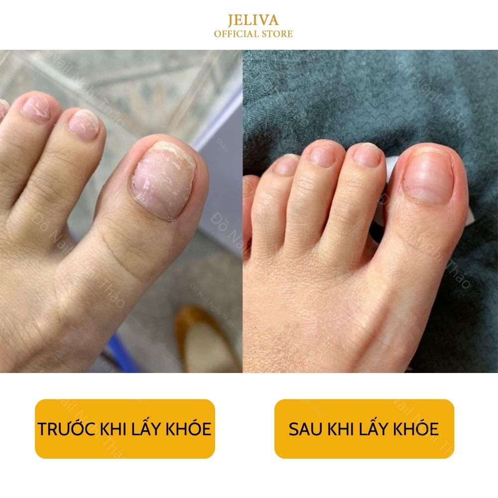 Cây lấy khóe móng chân cán gỗ
