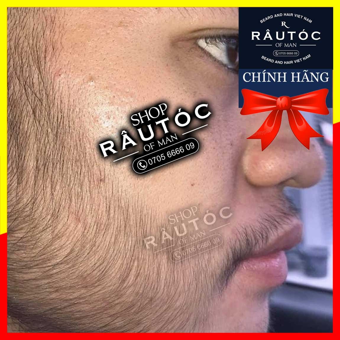 [HCM]RETINOL mix vào Minoxidil hỗ trợ mọc râu tóc