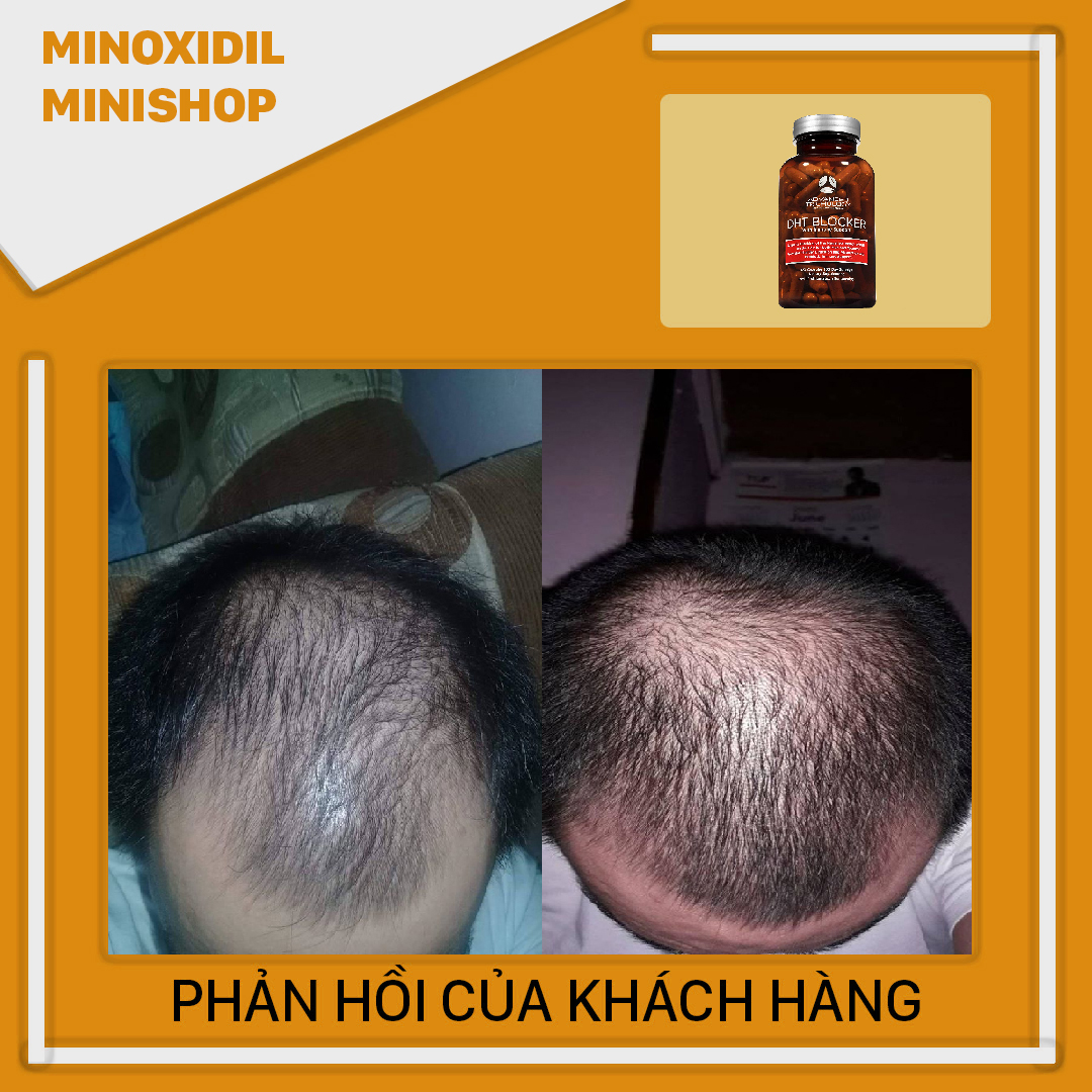 Advanced DHT Blocker chống rụng tóc