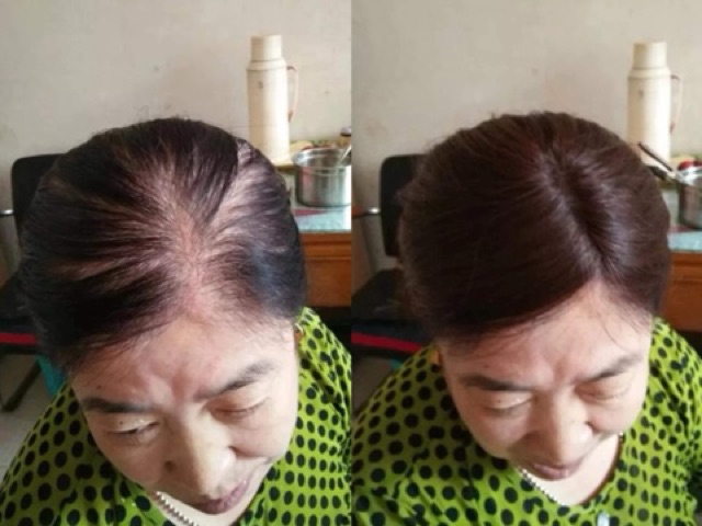 Tóc che hói/ Tóc giả che hói mái dài- tơ cao cấp