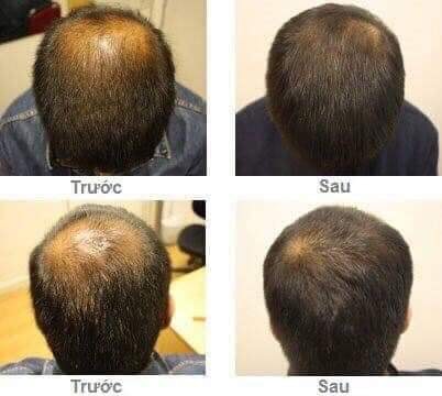 Xịt Mọc Tóc, Dưỡng Tóc MAHAAD -- Thái Lan (100% THẢO DƯỢC)