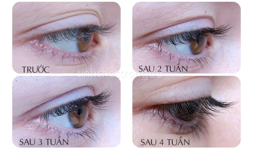 Thuốc mọc lông mày, dài mi Lumigan - Mỹ
