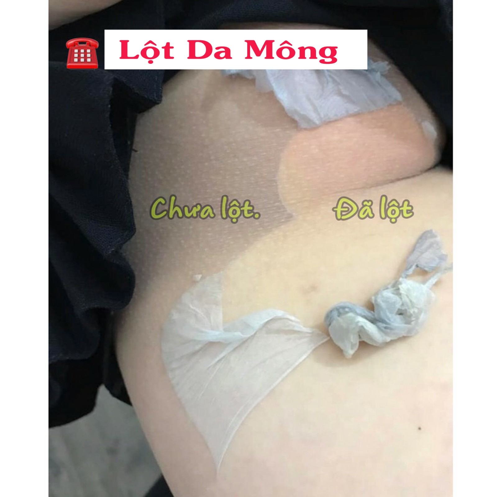 Lột Trắng Da Bụng Mông Bẹn Mờ Rạn Da Thâm Sạm
