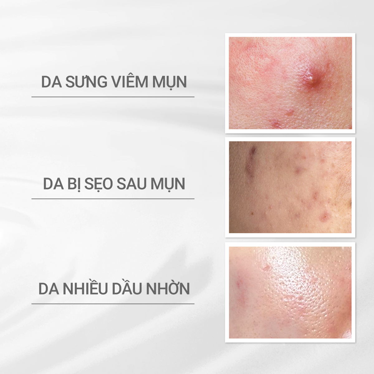 Oil-Control Moisturizer to Prevent Acne for Sensitive Skin Dprogram Balancing Acne Care Lotion 125ml