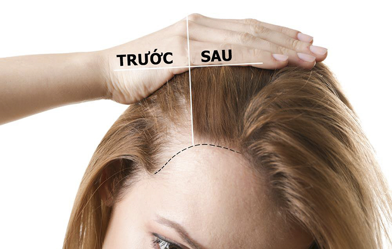 Xịt kích mọc tóc chống rụng SE Selen Compliment