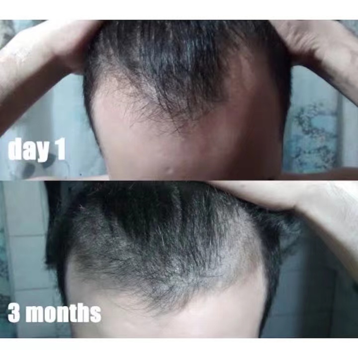 Minoxidil 15% (Bán chạy nhất) (Niêm phong) Sản xuất tại Thái Lan đích thực