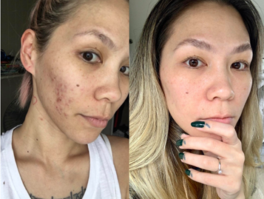 [HCM]Tinh chất The Ordinary AHA 30% + BHA 2% Peeling Solution - 30ml