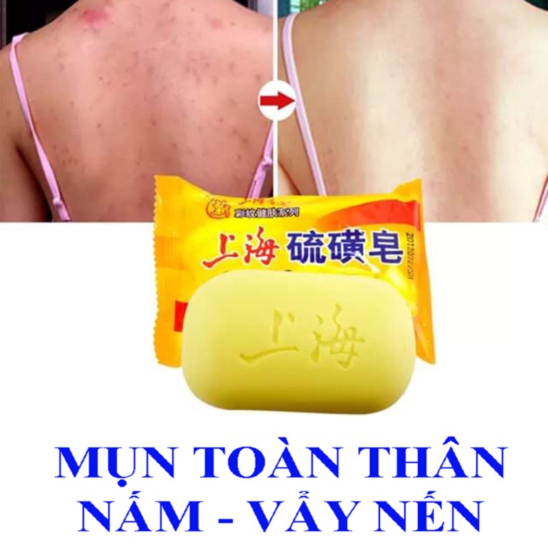Xà phòng tắm mụn toàn thân-Viêm nang lông, nấm ngứa giá rẻ