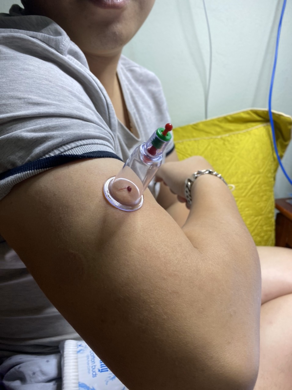 Bộ giác hơi hút máu bầm 10 ống