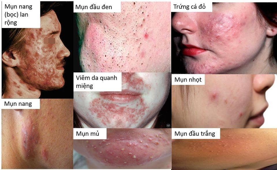 Combo 2 chai chấm mụn FOB 10 Lotion